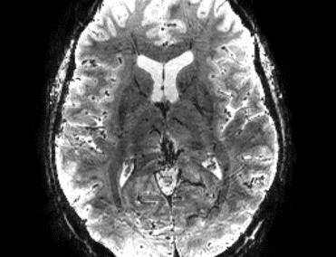 ELASTOBRAIN – A UNIGE MRI Study